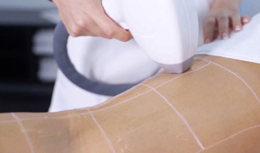 why-choose-elysion-laser